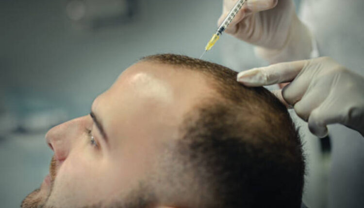 Hair Loss Treatment For Men